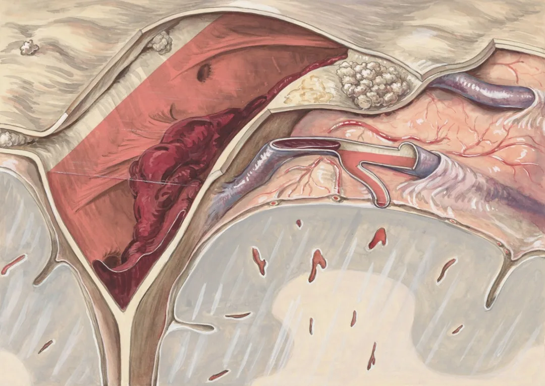 Understanding Atrial Fibrillation AFib